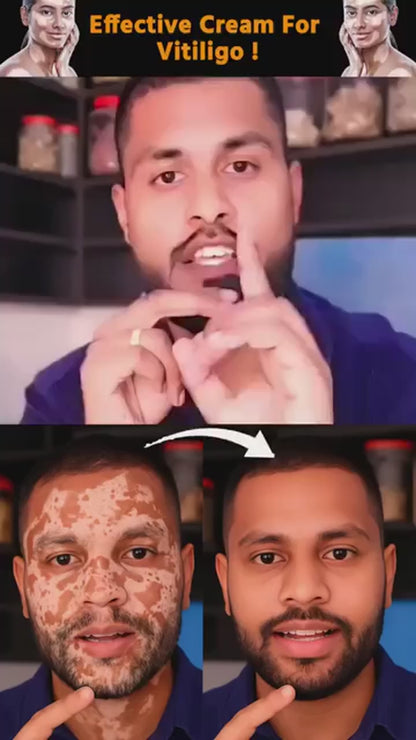 Fivfivgo Vitigo Bee Venom Correcting Cream 20g | Skin Tone Balancing And Pigmentation Repair Cream